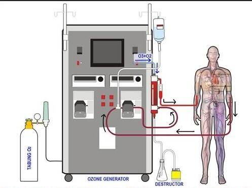 Sejarah Ozone Melumpuhkan Penyakit