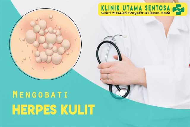 Mengobati Herpes Kulit