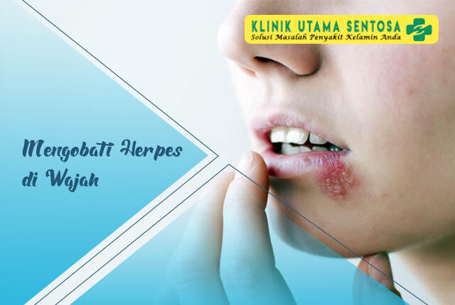 Mengobati Herpes di Wajah