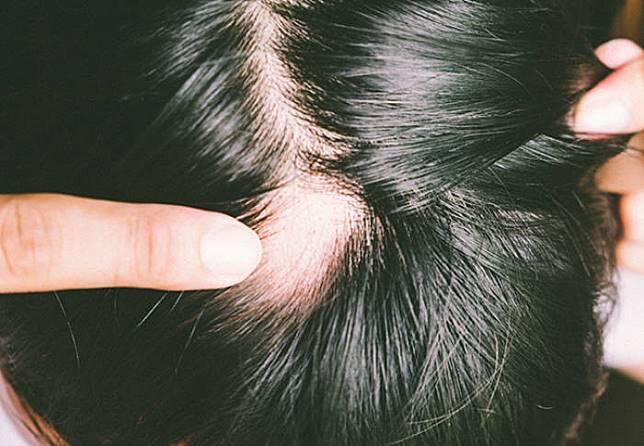 &#91;SHARING PENGALAMAN!&#93; Bertahun - tahun susahnya melawan rambut rontok #Antirontok #