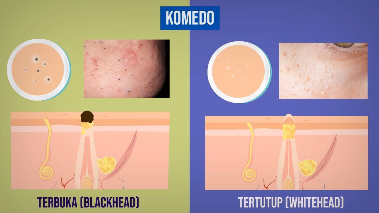 JERAWAT BANDEL? INI PRINSIP PENGOBATAN JERAWAT YG BENAR!