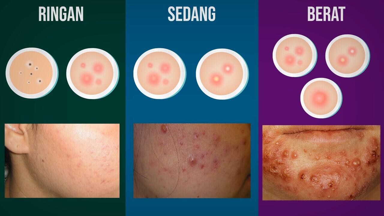 JERAWAT BANDEL? INI PRINSIP PENGOBATAN JERAWAT YG BENAR!