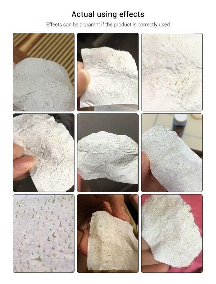 Putih Telur+tisu Bisa Bantu Angkat Komedo? Bisa Banget! 