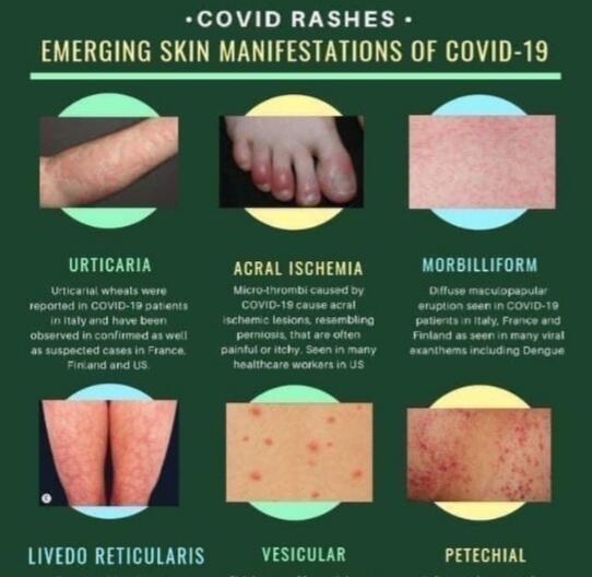 Dokter Ungkap Adanya Fenomena "Covid Toes', Ruam Pada Jari Kaki Pasien Corona