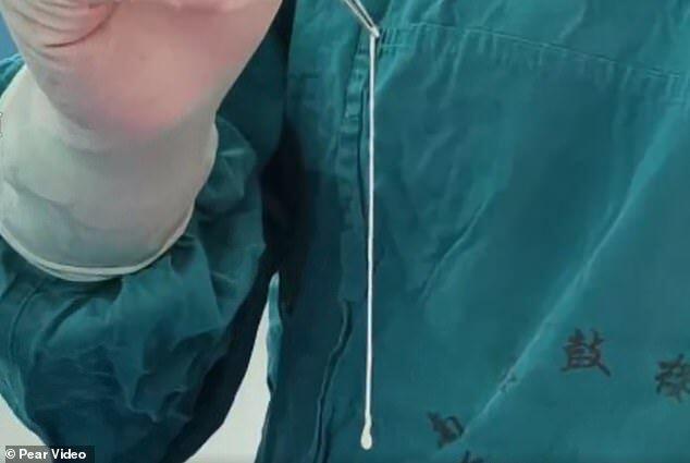 Hobi Makan Daging Mentah, Otak Wanita Ini Dipenuhi Cacing Hidup