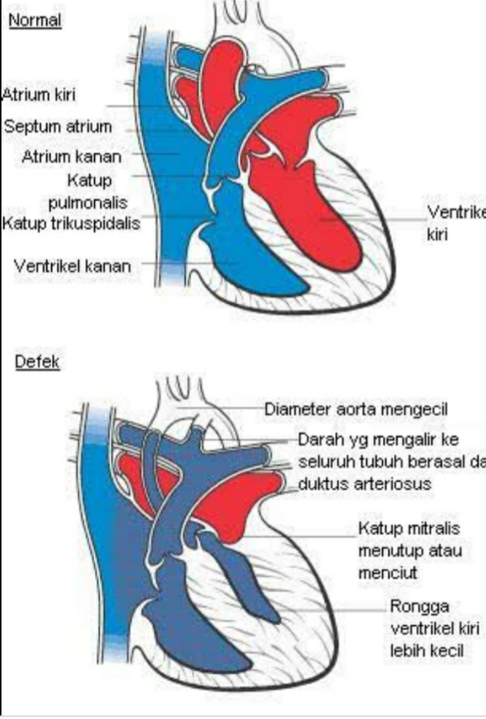 Mengenal Penyakit Sindrom Jantung Kiri Hipoplastik Pada Bayi