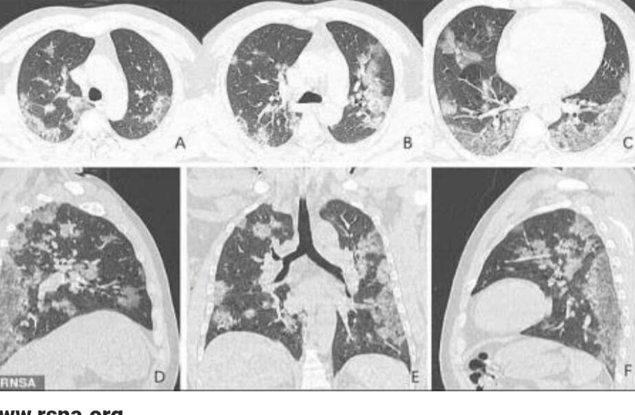 Hasil CT Scan, Kasus Covid-19 di Perancis Telah Ada Sejak November 2019