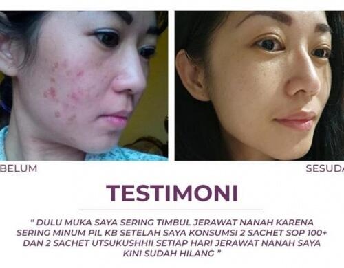 🔴 SOP100+ by AFC Life Science. | Solusi Kesehatan Anda | 100% Made in Japan