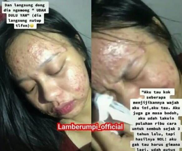 Viral Curhat Sedih Pejuang Acne Ditolak Cowok Gegara Jerawatan 