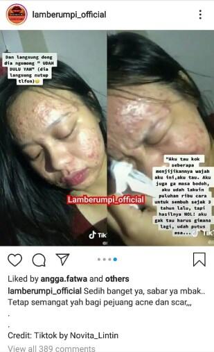 Viral Curhat Sedih Pejuang Acne Ditolak Cowok Gegara Jerawatan 