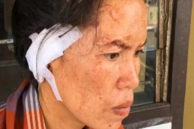 Pria Ini Tega Potong Daun Telinga Istrinya Hanya Karena Jarang Disiapkan Makanan