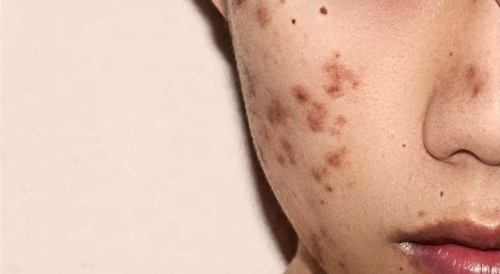 8 Penyebab flek hitam/ Ephelis
