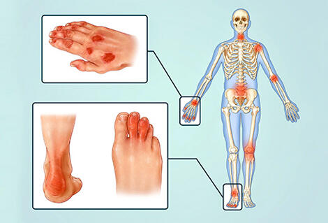 Sering Menggunakan Mouse Dan Touchscreen Terancam Arthritis, Benarkah Itu?