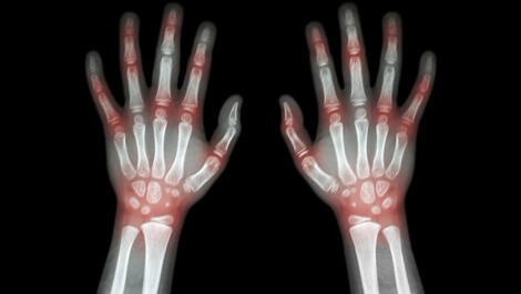 Sering Menggunakan Mouse Dan Touchscreen Terancam Arthritis, Benarkah Itu?