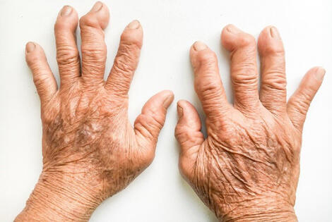 Sering Menggunakan Mouse Dan Touchscreen Terancam Arthritis, Benarkah Itu?