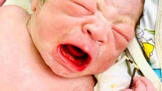 Bayi Ini Keluar dari Rahim Ibunya Sambil Pegang Alat Kontrasepsi