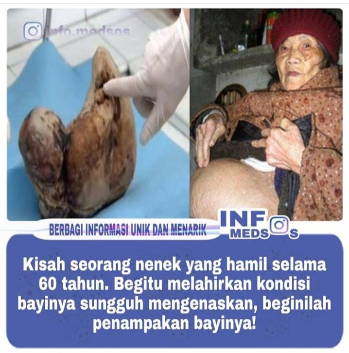 Bayi Berusia Puluhan Tahun Ini Akhirnya Lahir Walaupun Dalam Keadaan Yang Mengerikan
