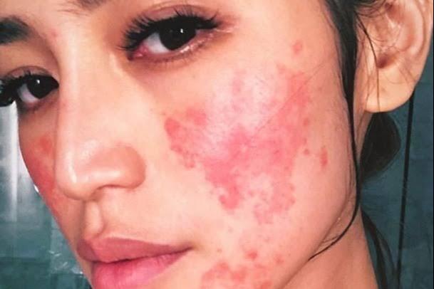 Inilah 5 Tips, Wajah Kamu Tidak Cocok Dengan Skincare Yang Sista Pakai