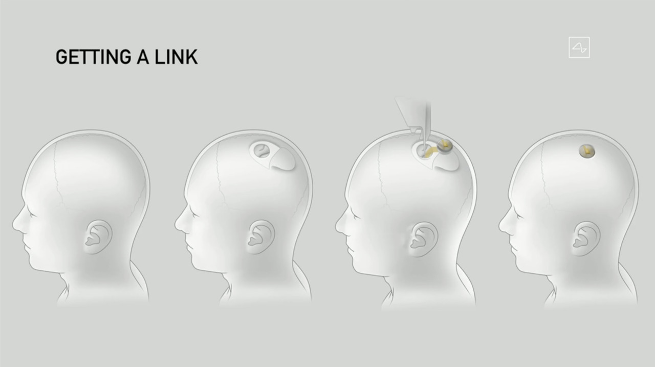 Apa itu Neuralink dan Bagaimana Cara Kerjanya ?