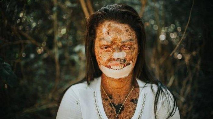 Cinta Tidak Melulu Soal Fisik! Wanita Kelainan Kulit Langka, di Nikahi Pria Tampan