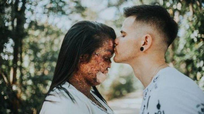 Cinta Tidak Melulu Soal Fisik! Wanita Kelainan Kulit Langka, di Nikahi Pria Tampan