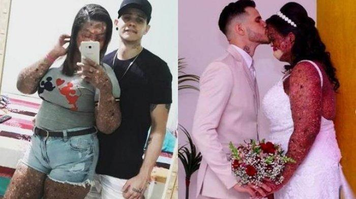 Cinta Tidak Melulu Soal Fisik! Wanita Kelainan Kulit Langka, di Nikahi Pria Tampan