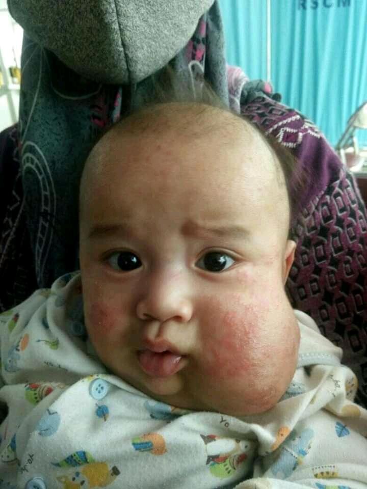 Butuh Bantuan Donasi Buat Anak Kena Tumor Pipi Sejak Lahir