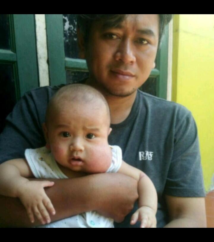 Butuh Bantuan Donasi Buat Anak Kena Tumor Pipi Sejak Lahir