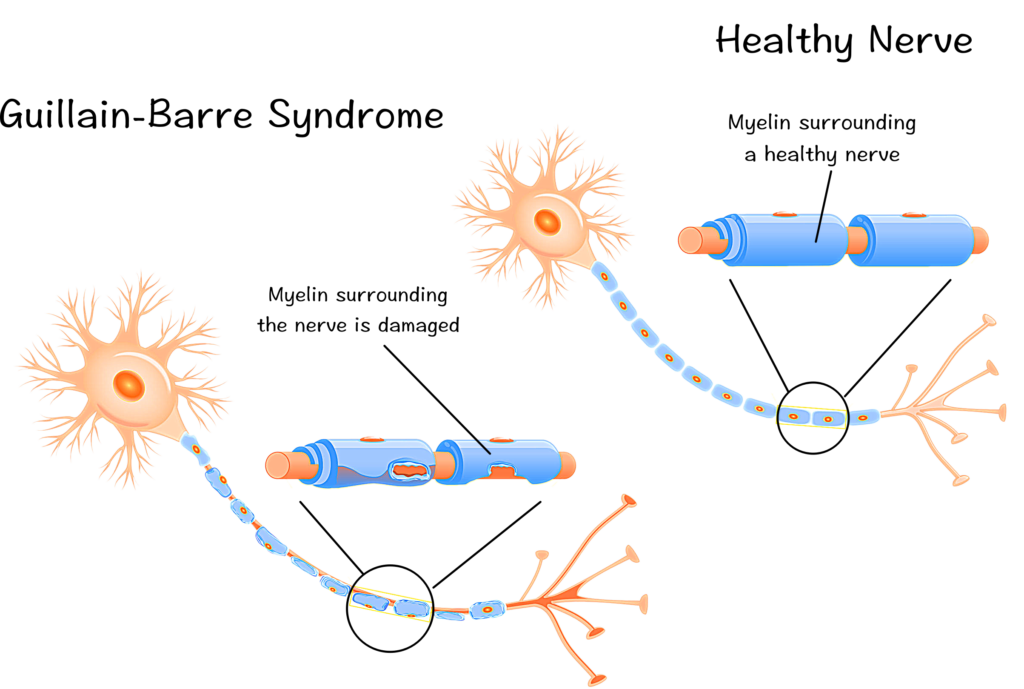 Guillain Barre Syndrome ( GBS ), Apakah Latihan dapat menunda pemulihan ??