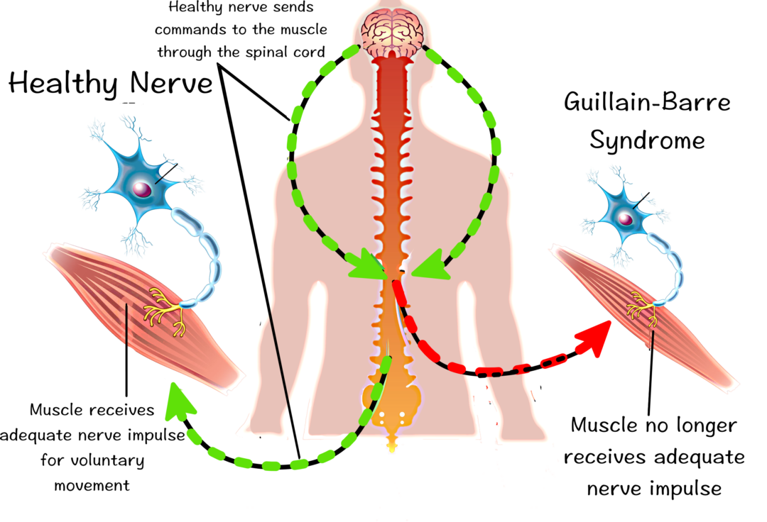 Guillain Barre Syndrome ( GBS ), Apakah Latihan dapat menunda pemulihan ??