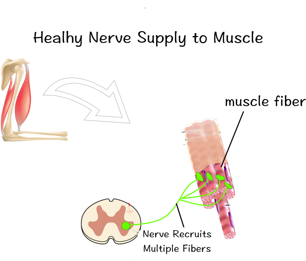 Guillain Barre Syndrome ( GBS ), Apakah Latihan dapat menunda pemulihan ??