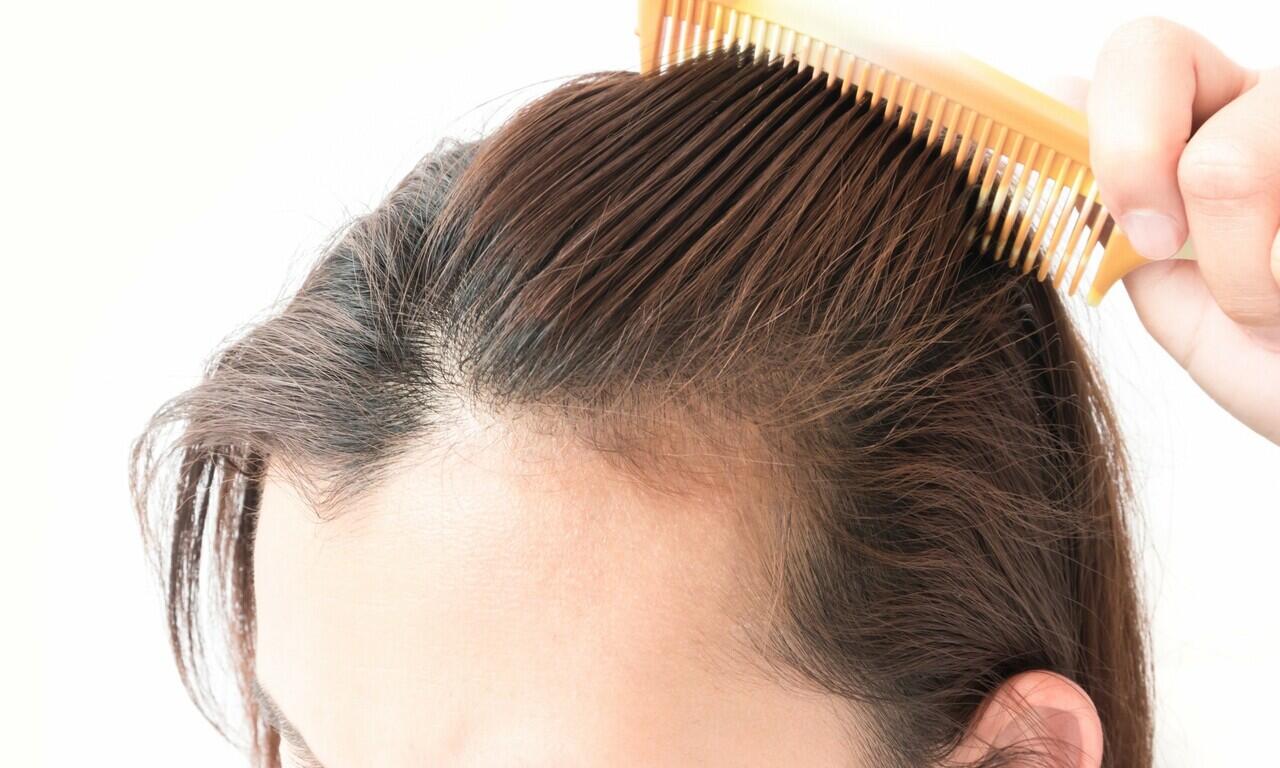 5 Makanan Yang Nyatanya Bisa Menjadi Penyebab Rambut Rontok