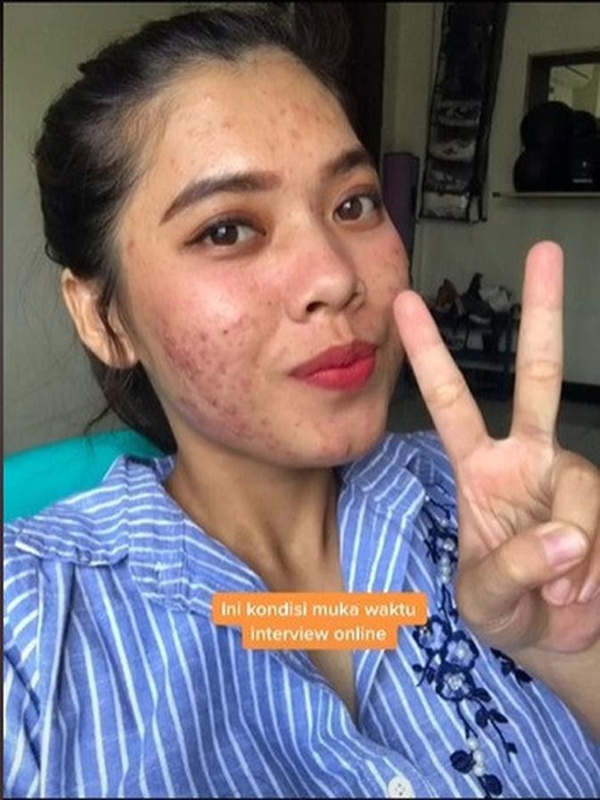 Viral Curhatan Wanita yang Gagal Diterima Kerja karena Jerawat