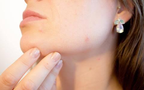 Pakai Sunscreen Malah Breakout? Kenali Jenis Sunscreen yang Cocok untuk Jenis Kulitmu