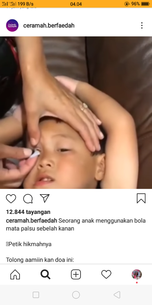 Melihat Caranya Memakai Mata Palsu, Sudahkah Kita Bersyukur?