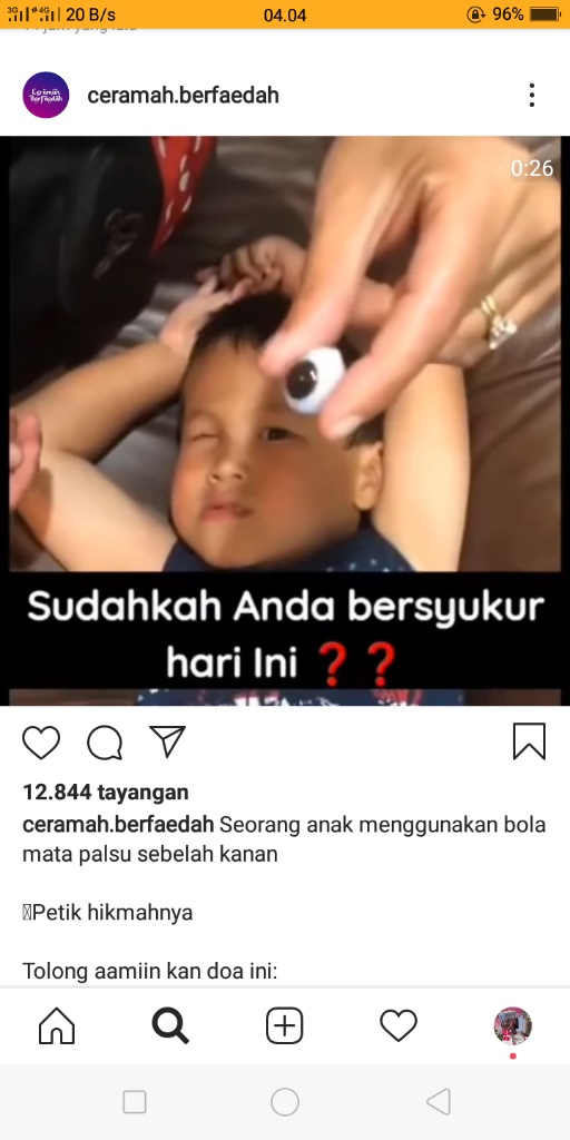 Melihat Caranya Memakai Mata Palsu, Sudahkah Kita Bersyukur?