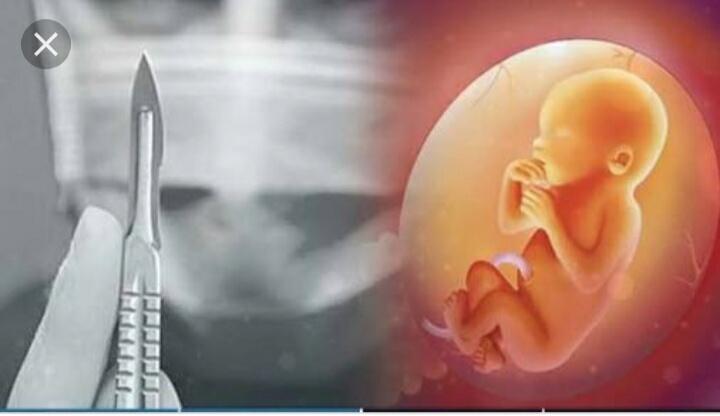 Sungguh Ngeri! Beginilah Simulasi Aborsi Dengan Metode Dilatasi dan Evakuasi