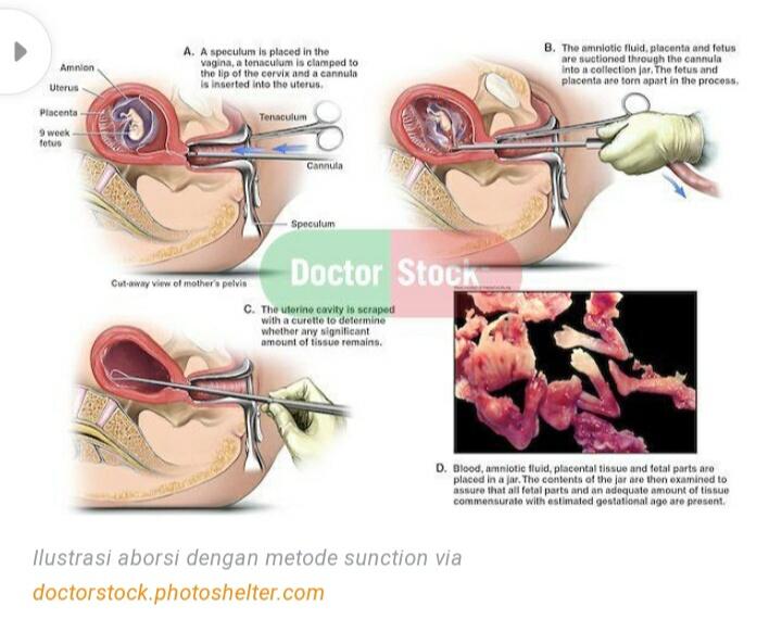 Sungguh Ngeri! Beginilah Simulasi Aborsi Dengan Metode Dilatasi dan Evakuasi