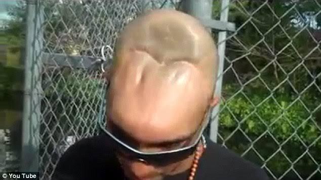 Carloz Rodriguez, Pria Yang Hidup Setelah Kehilangan 1/2 Otaknya