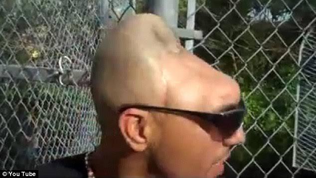 Carloz Rodriguez, Pria Yang Hidup Setelah Kehilangan 1/2 Otaknya