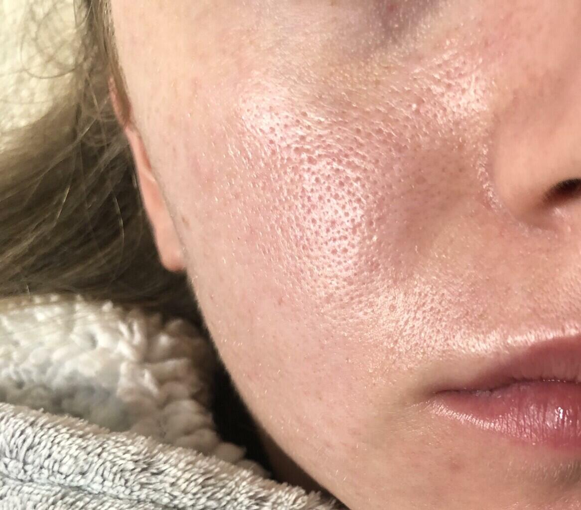 WAJIB TAHU!! Inilah Mitos & Fakta Seputar Pori-Pori Besar.