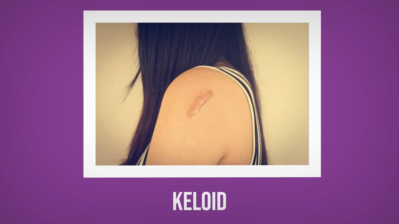 CARA MENGHILANGKAN KELOID