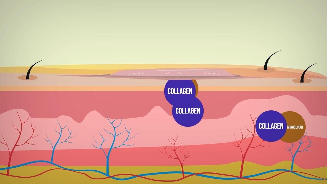 CARA MENGHILANGKAN KELOID