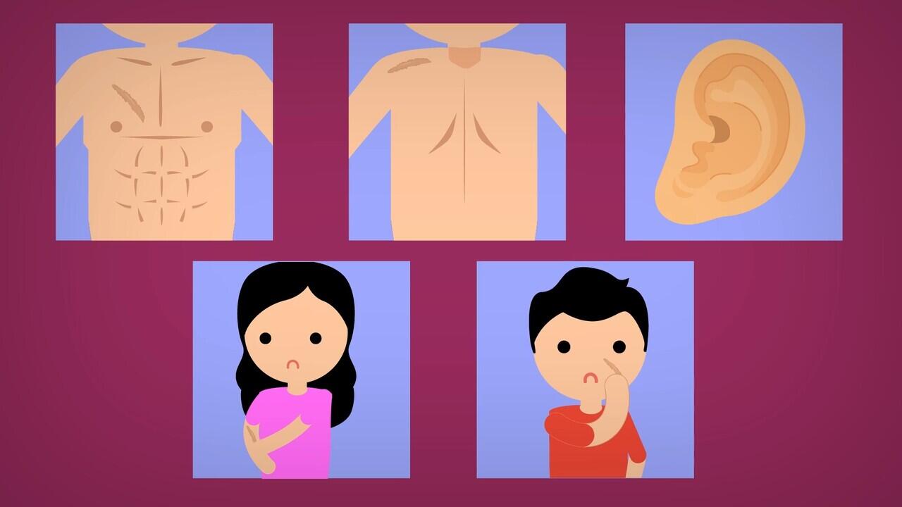 CARA MENGHILANGKAN KELOID