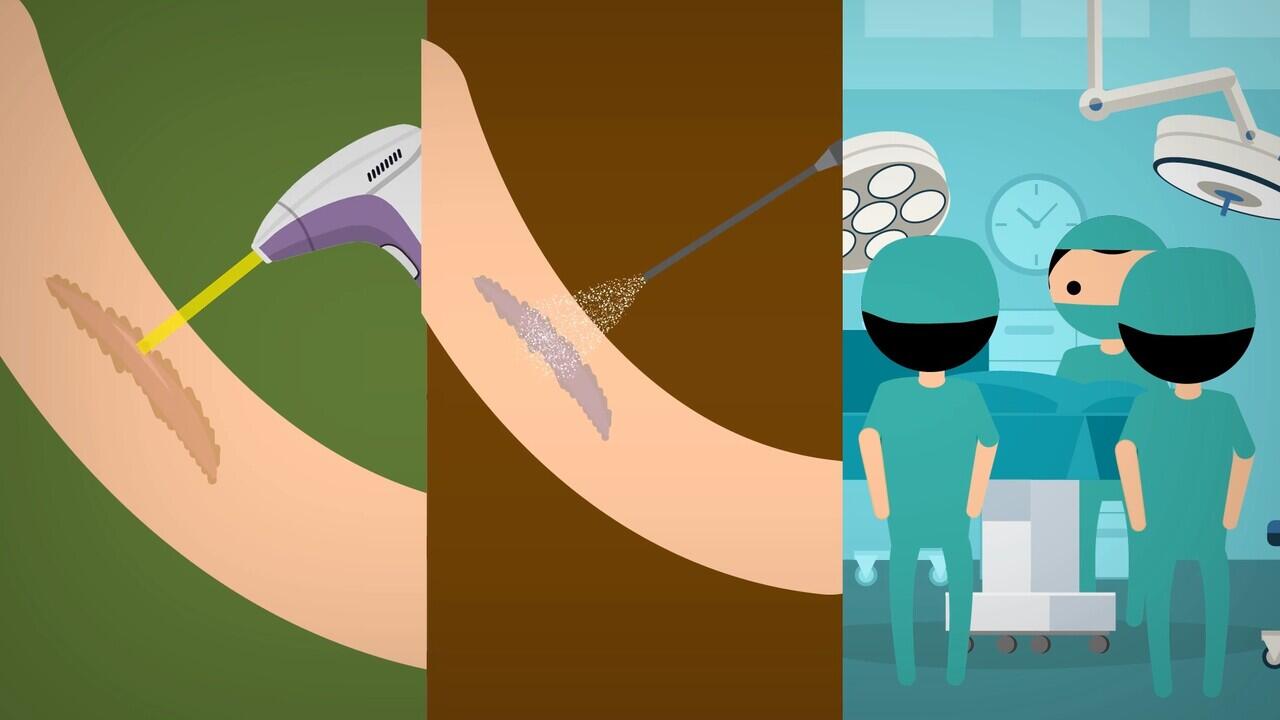 CARA MENGHILANGKAN KELOID
