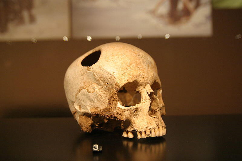 Trepanation! Operasi Bedah Ekstrem Yang Mengharuskan Kepala Manusia Dilubangi!