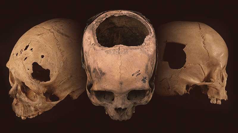 Trepanation! Operasi Bedah Ekstrem Yang Mengharuskan Kepala Manusia Dilubangi!