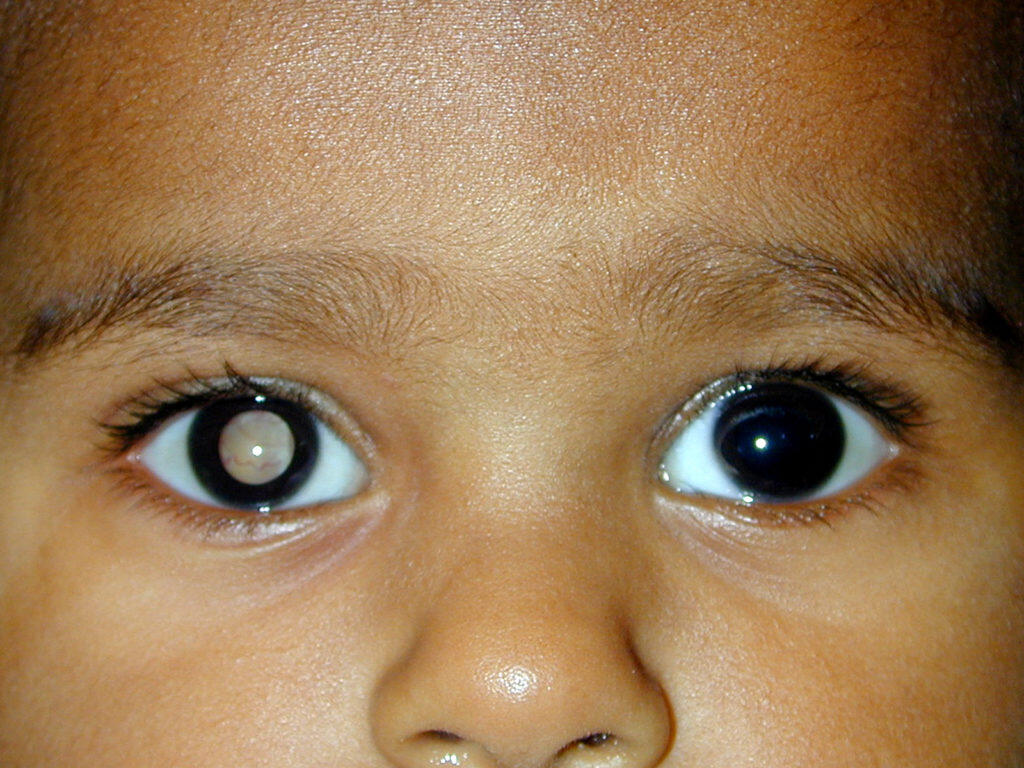 Mengenal Retinoblastoma, Penyakit Kanker Mata Yang Langka