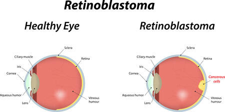 Mengenal Retinoblastoma, Penyakit Kanker Mata Yang Langka