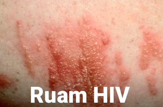 Ciri Bentuk Ruam HIV Yang Mudah Dilihat